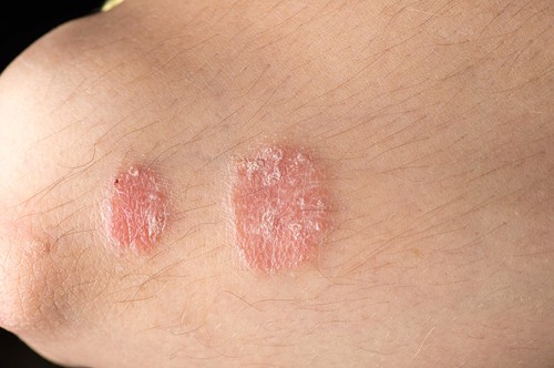 Da bị đỏ mẩn ngứa tróc vẩy: Dấu hiệu cảnh báo bệnh chàm (viêm da cơ địa, eczema)